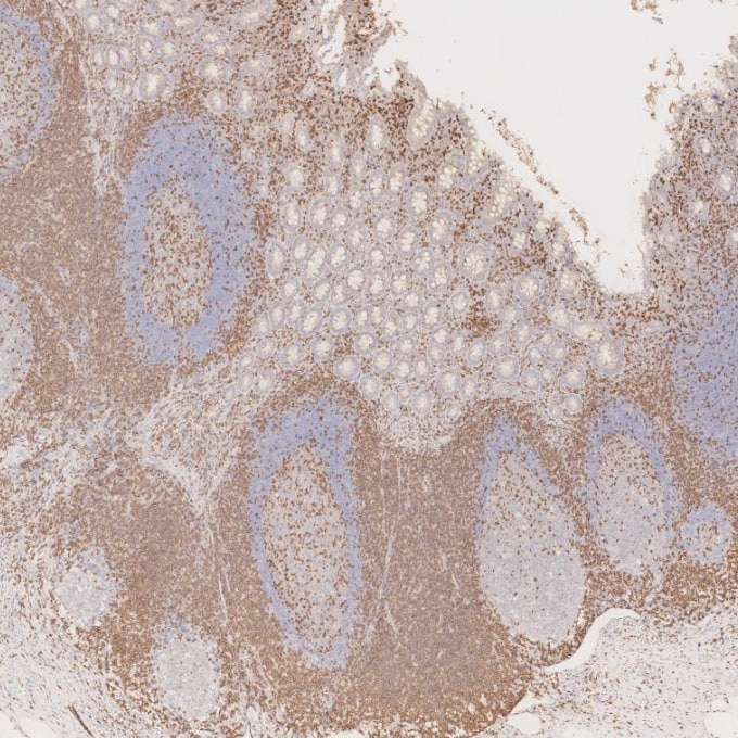 Immunohistochemistry (IHC) staining of human appendicitis tissue using CD3 Monoclonal antibody (60181-1-Ig)