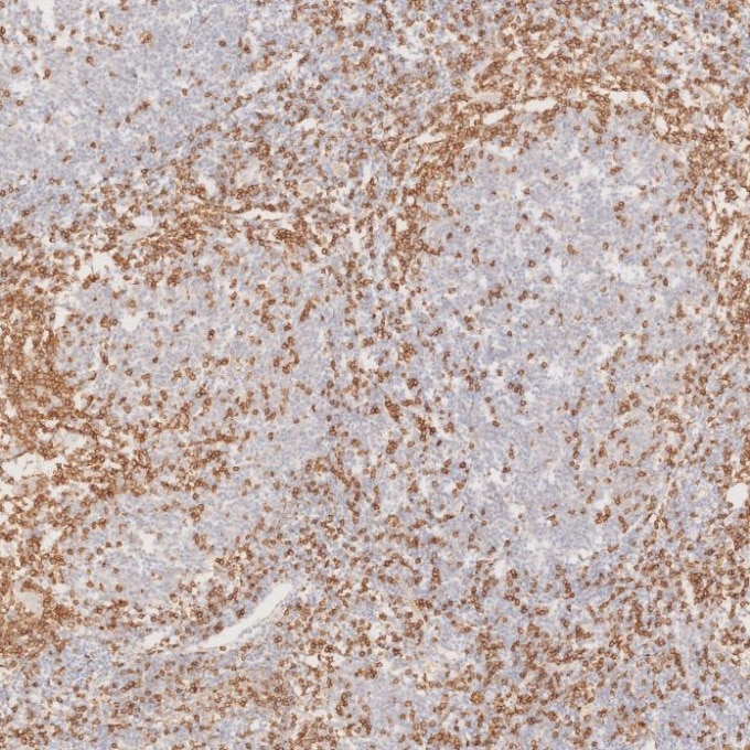 Immunohistochemistry (IHC) staining of human lymphoma tissue using CD3 Monoclonal antibody (60181-1-Ig)
