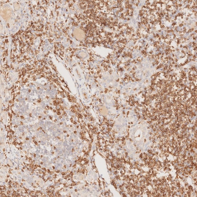 Immunohistochemistry (IHC) staining of human lymphoma tissue using CD3 Monoclonal antibody (60181-1-Ig)