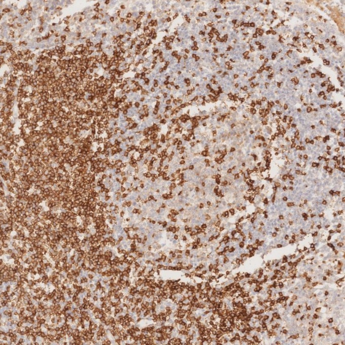Immunohistochemistry (IHC) staining of human tonsillitis tissue using CD3 Monoclonal antibody (60181-1-Ig)