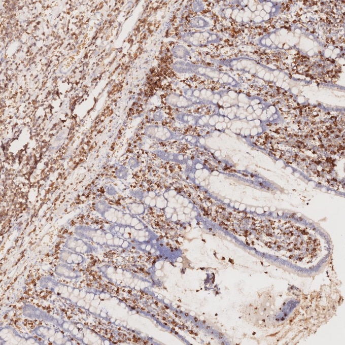 Immunohistochemistry (IHC) staining of human lymphoma tissue using CD3 Monoclonal antibody (60181-1-Ig)