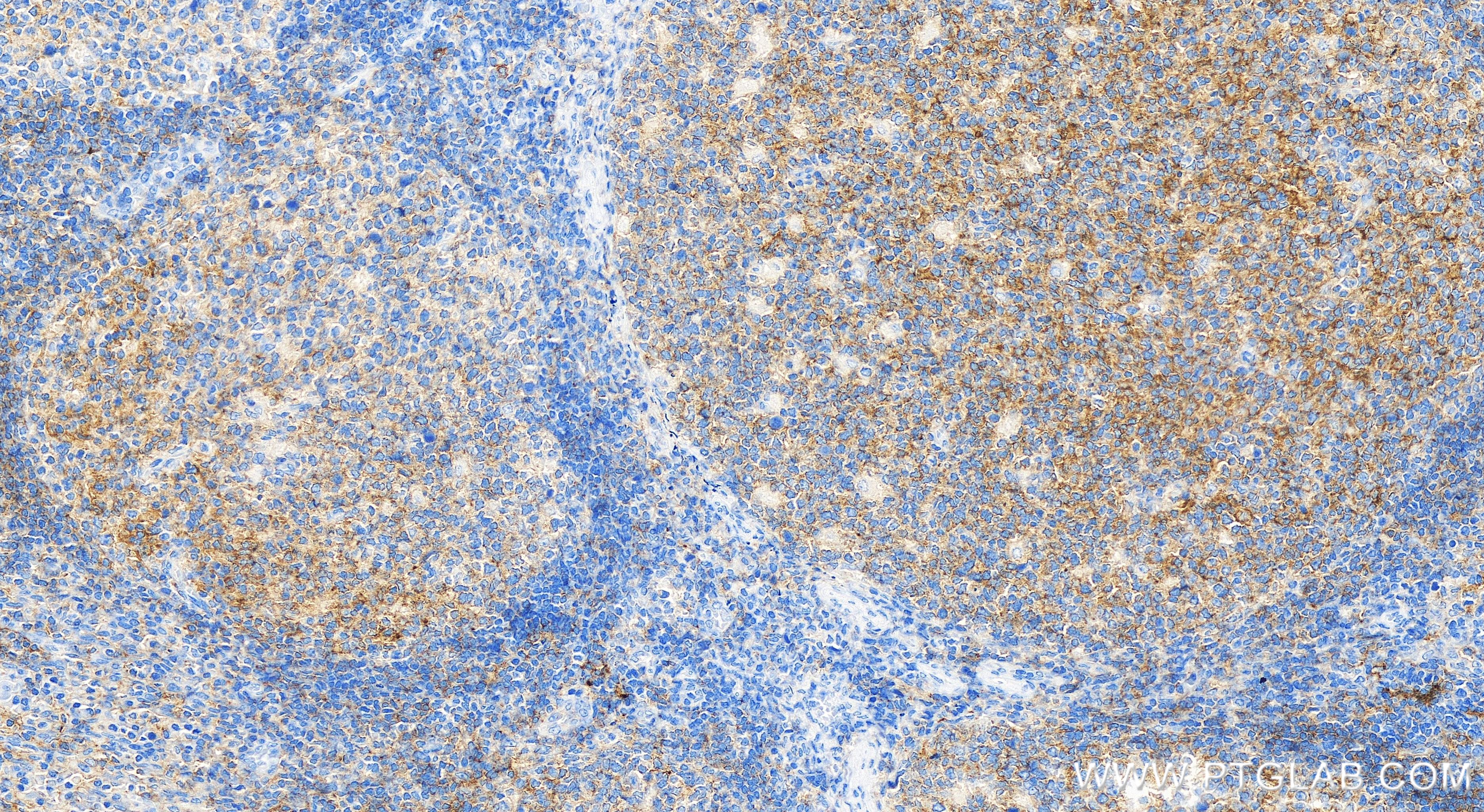 Immunohistochemistry (IHC) staining of human tonsillitis tissue using CD40 Recombinant antibody (84406-1-RR)