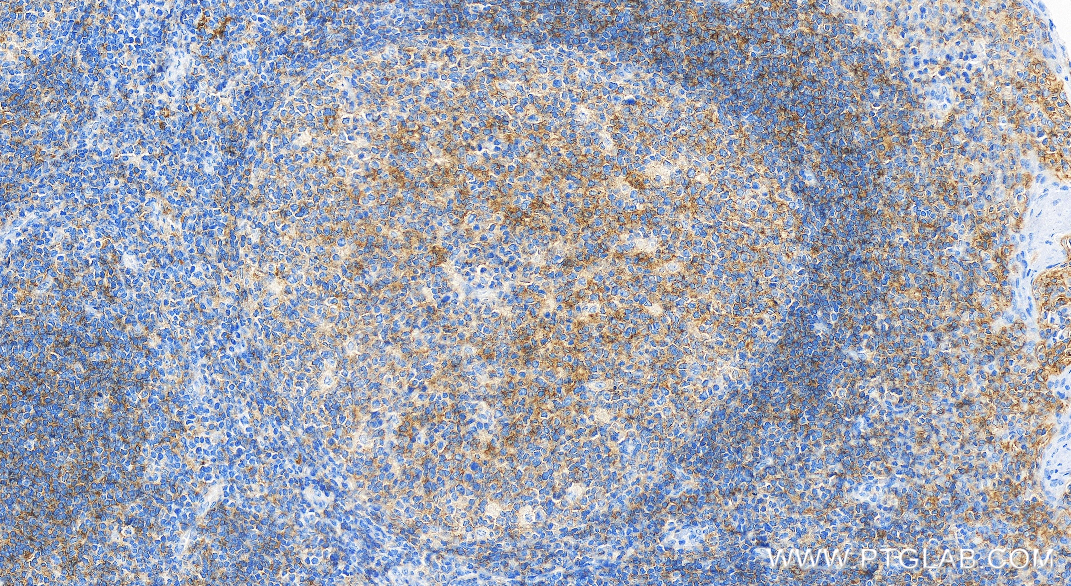 Immunohistochemistry (IHC) staining of human tonsillitis tissue using CD40 Recombinant antibody (84406-1-RR)