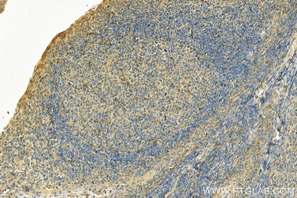 Immunohistochemistry (IHC) staining of human tonsillitis tissue using CD40L/CD154 Polyclonal antibody (16668-1-AP)