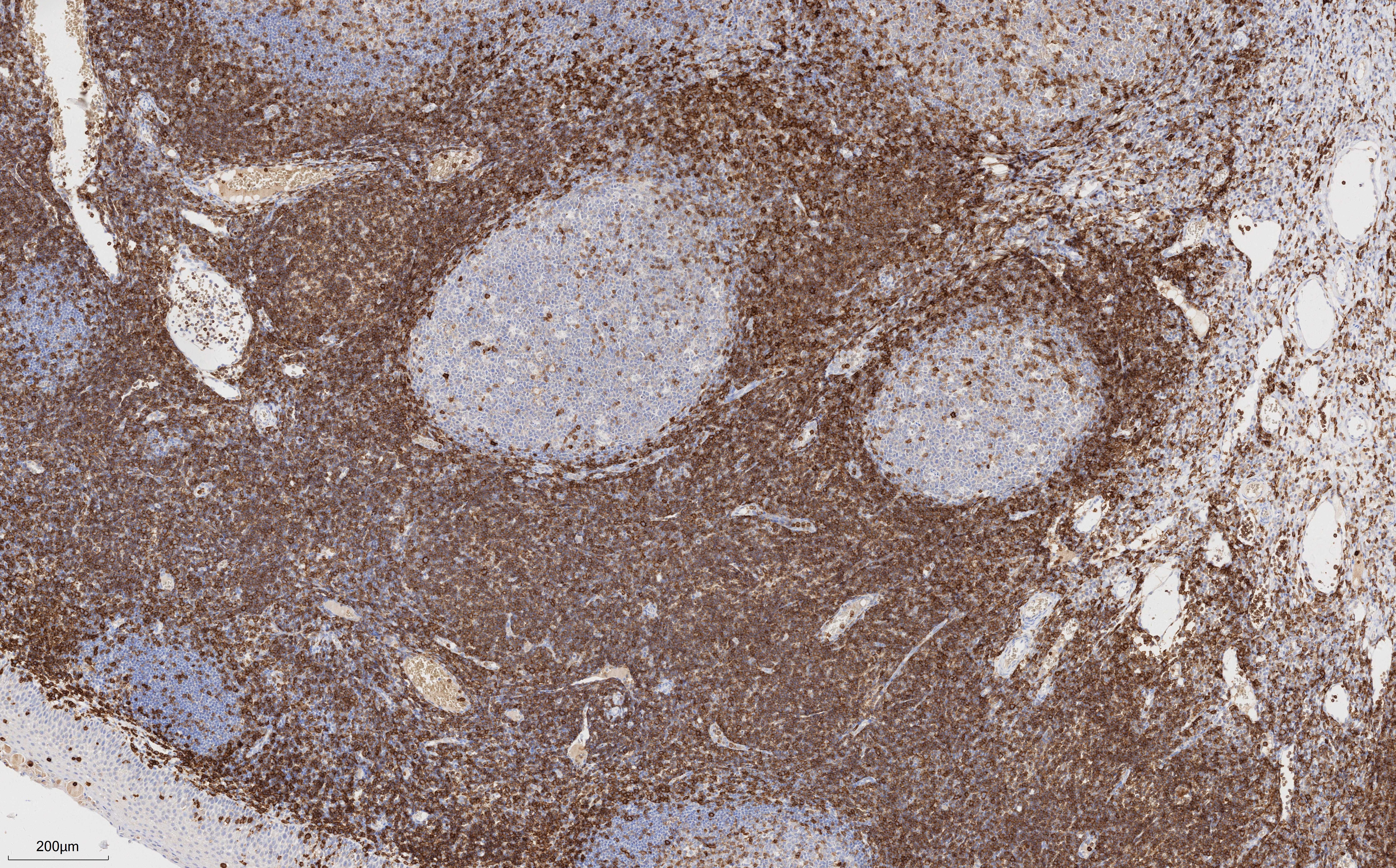 Immunohistochemistry (IHC) staining of human tonsillitis tissue using CD43 Monoclonal antibody (66224-1-Ig)