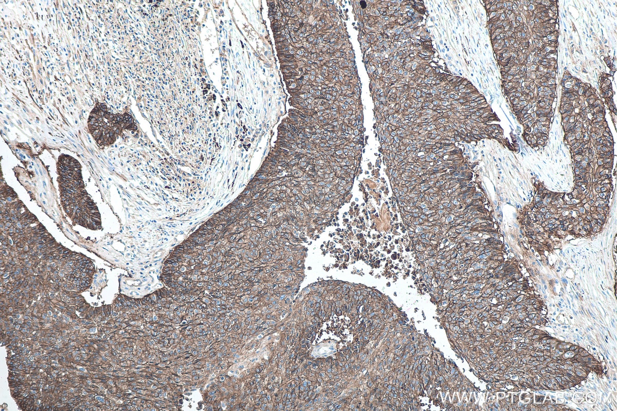Immunohistochemistry (IHC) staining of human lung cancer tissue using CD44 Monoclonal antibody (60224-1-Ig)