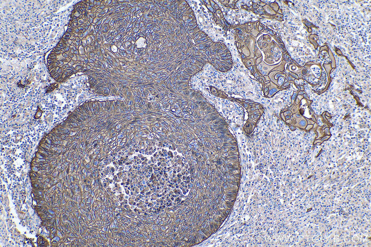 Immunohistochemistry (IHC) staining of human lung cancer tissue using CD44 Monoclonal antibody (60224-1-Ig)