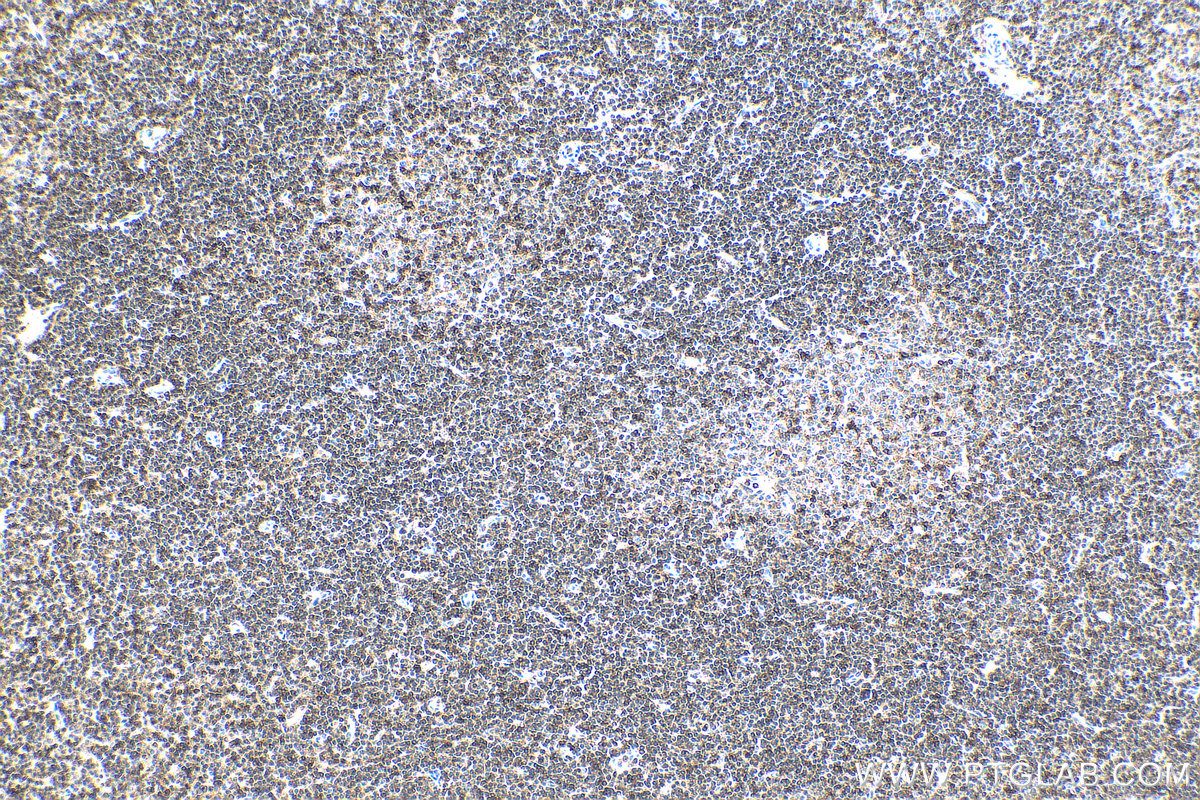 Immunohistochemistry (IHC) staining of human lymphoma tissue using CD45 Monoclonal antibody (60287-1-Ig)