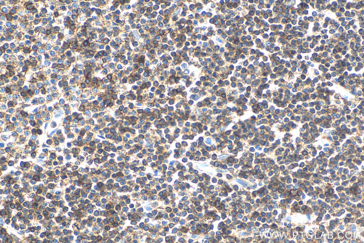 Immunohistochemistry (IHC) staining of human lymphoma tissue using CD45 Monoclonal antibody (60287-1-Ig)