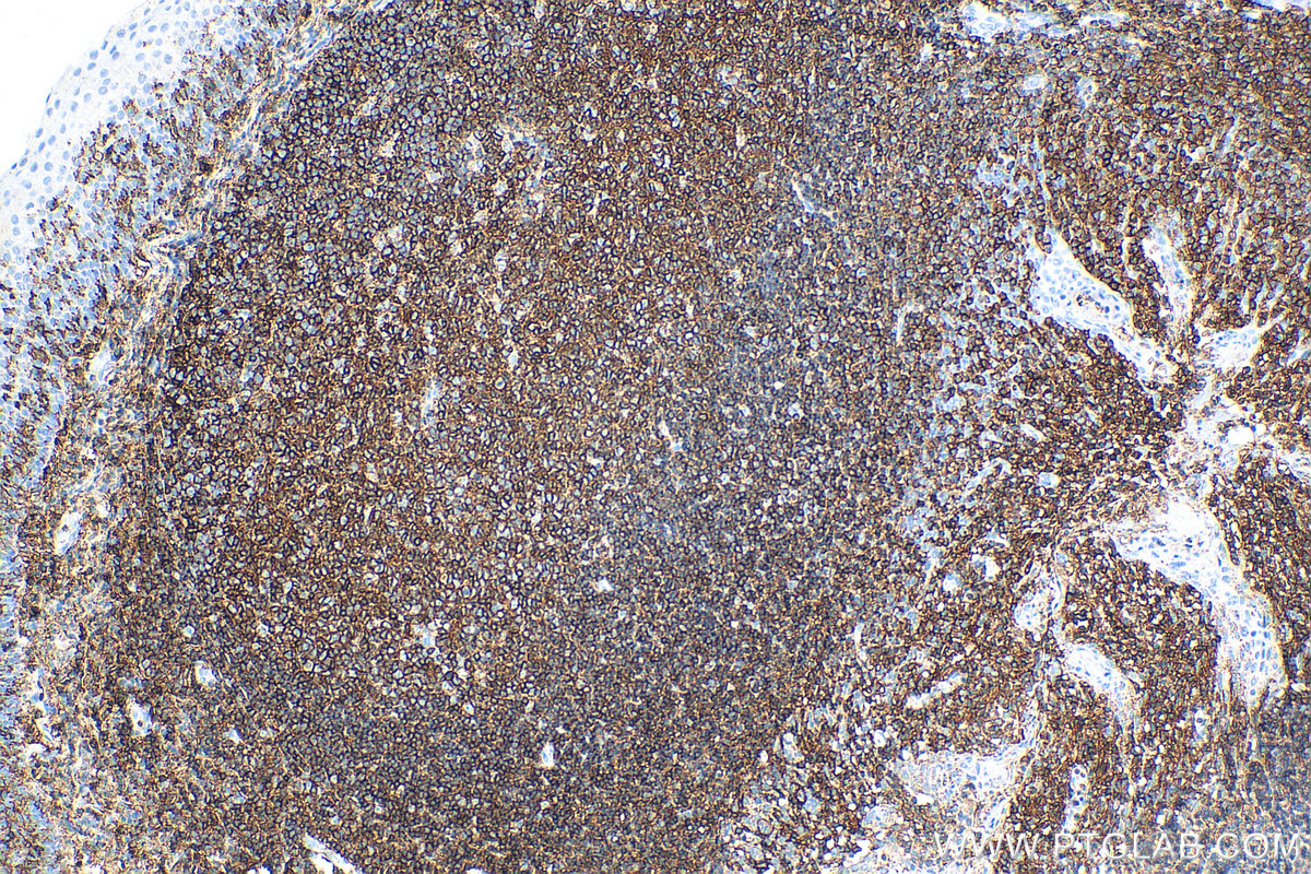 Immunohistochemistry (IHC) staining of human tonsillitis tissue using CD45 Recombinant antibody (80297-1-RR)