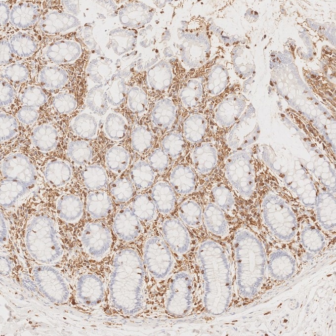 Immunohistochemistry (IHC) staining of human colorectal cancer tissue using CD45 Recombinant monoclonal antibody (80297-1-RR)