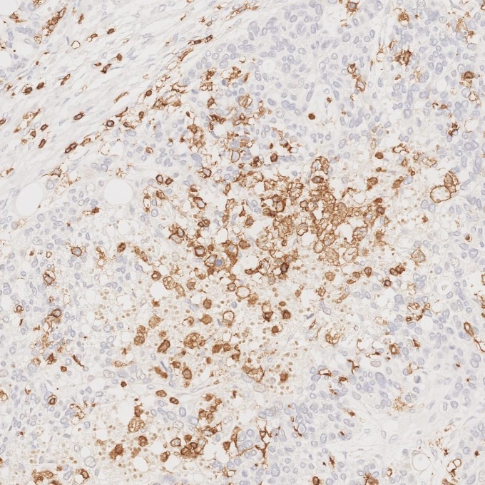 Immunohistochemistry (IHC) staining of human ovary cancer tissue using CD45 Recombinant monoclonal antibody (80297-1-RR)