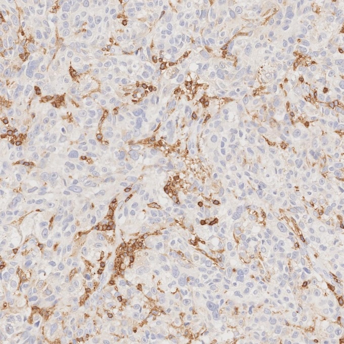 Immunohistochemistry (IHC) staining of human malignant melanoma tissue using CD45 Recombinant monoclonal antibody (80297-1-RR)