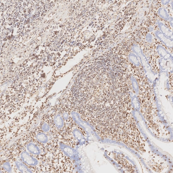 Immunohistochemistry (IHC) staining of human lymphoma tissue using CD45 Recombinant monoclonal antibody (80297-1-RR)