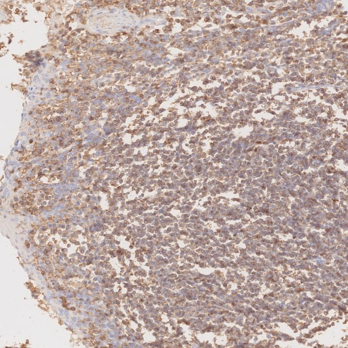 Immunohistochemistry (IHC) staining of human tonsillitis tissue using CD45 Recombinant monoclonal antibody (80297-1-RR)