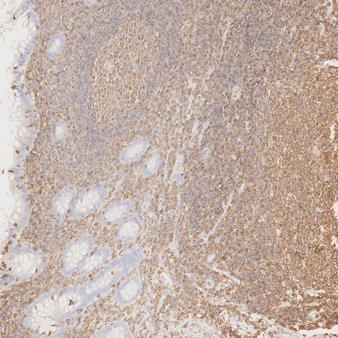 Immunohistochemistry (IHC) staining of human appendicitis tissue using CD45 Recombinant monoclonal antibody (80297-1-RR)