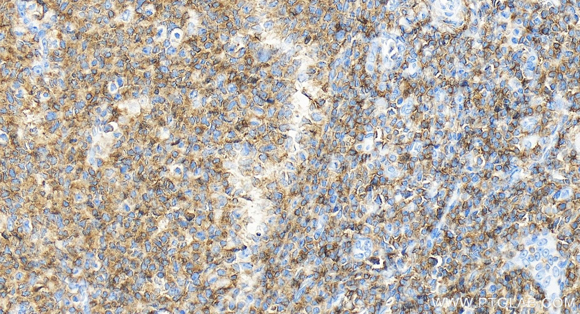 Immunohistochemistry (IHC) staining of human tonsillitis tissue using CD45 Recombinant antibody (84405-6-RR)