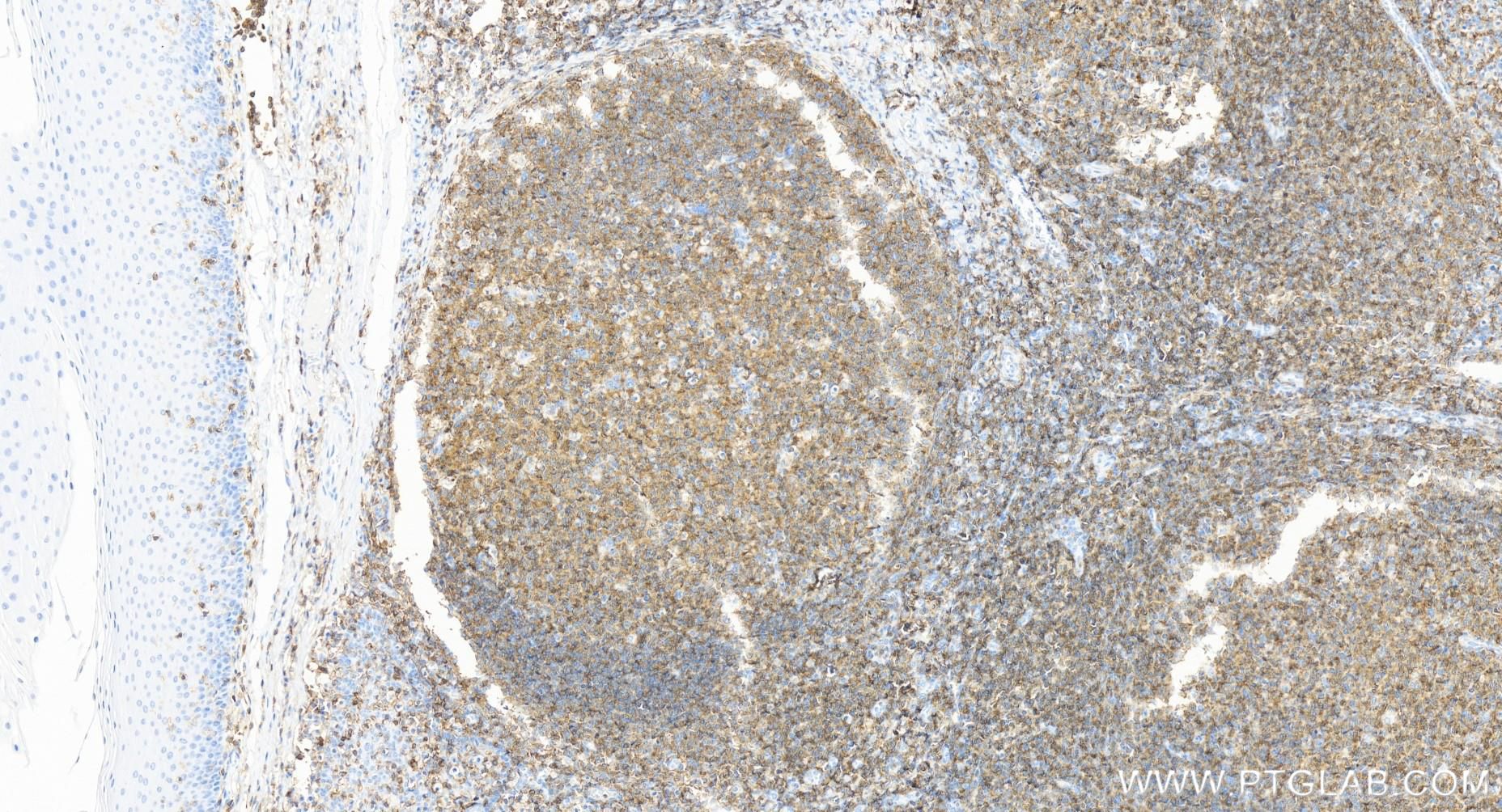 Immunohistochemistry (IHC) staining of human tonsillitis tissue using CD45 Recombinant antibody (84405-6-RR)