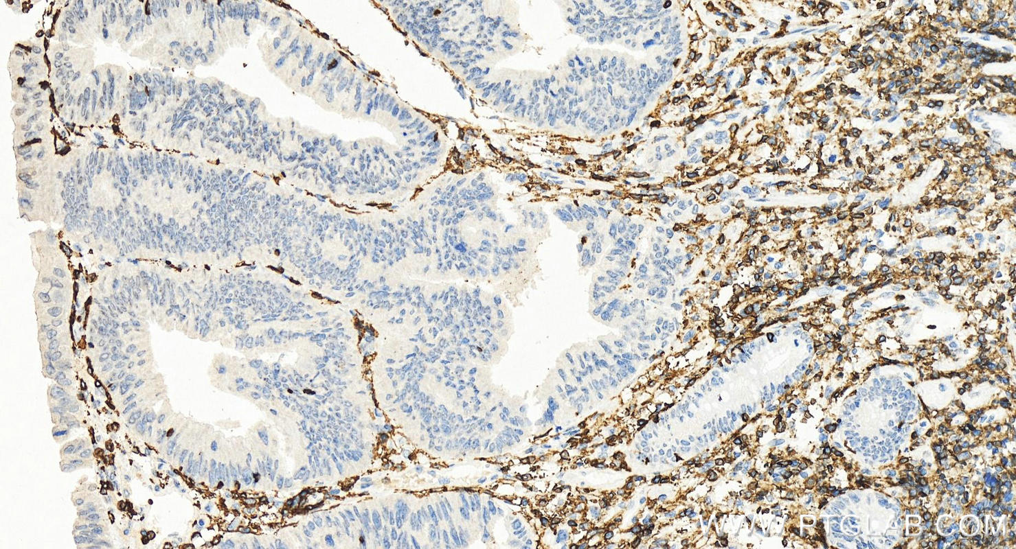 Immunohistochemistry (IHC) staining of human colon cancer tissue using Anti-Human CD45RO (UCHL1) (65150-1-Ig)