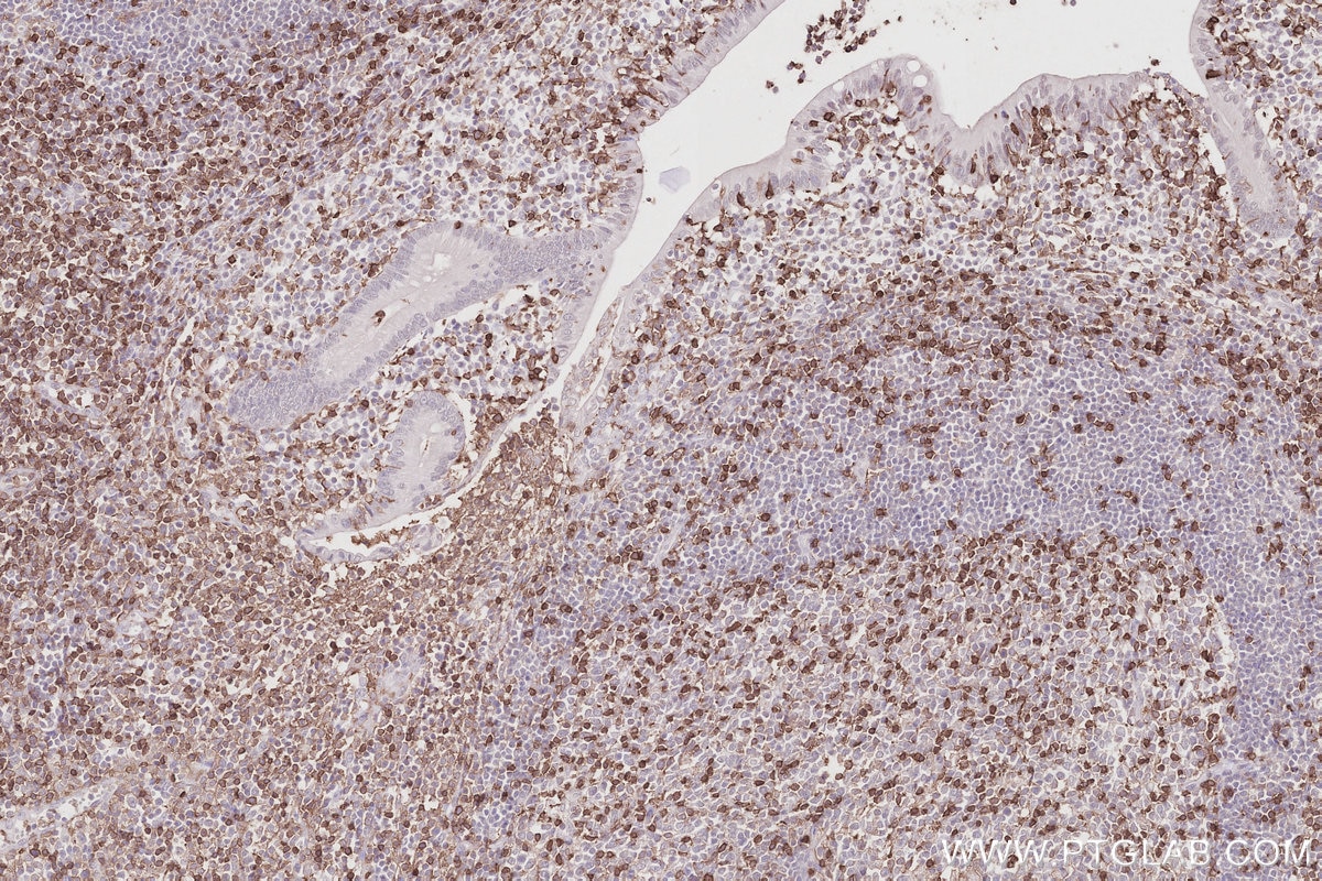 Immunohistochemistry (IHC) staining of human appendicitis tissue using Anti-Human CD45RO (UCHL1) (65150-1-Ig)