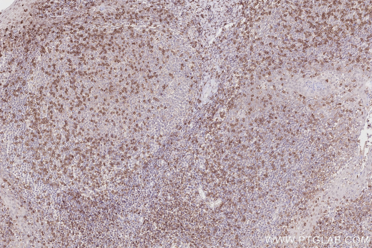 Immunohistochemistry (IHC) staining of human tonsillitis tissue using Anti-Human CD45RO (UCHL1) (65150-1-Ig)
