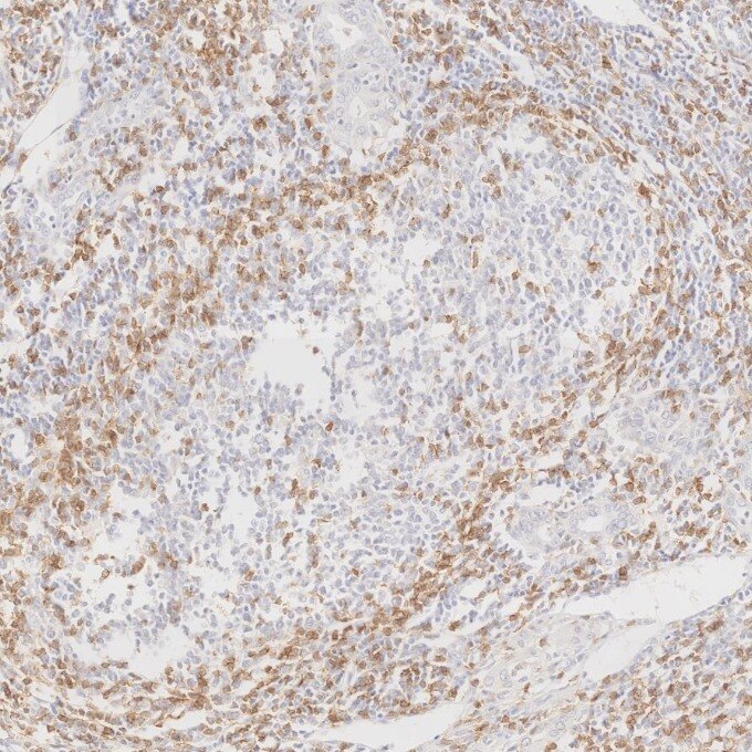 Immunohistochemistry (IHC) staining of human lymphoma tissue using Anti-Human CD45RO (UCHL1) (65150-1-Ig)