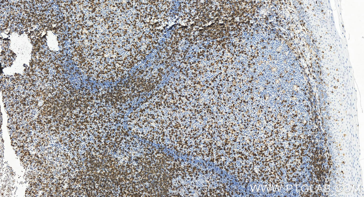 Immunohistochemistry (IHC) staining of human tonsillitis tissue using Anti-Human CD45RO (UCHL1) (65150-1-Ig)