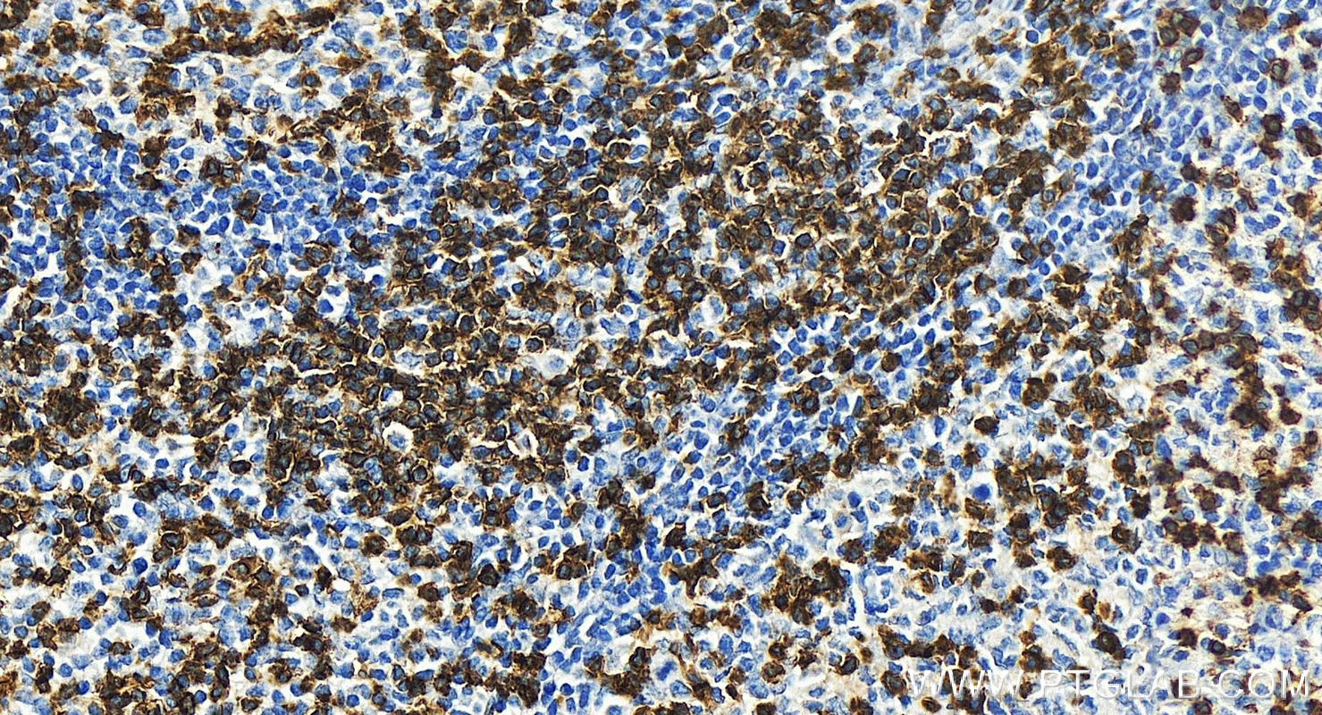 Immunohistochemistry (IHC) staining of human tonsillitis tissue using Anti-Human CD45RO (UCHL1) (65150-1-Ig)