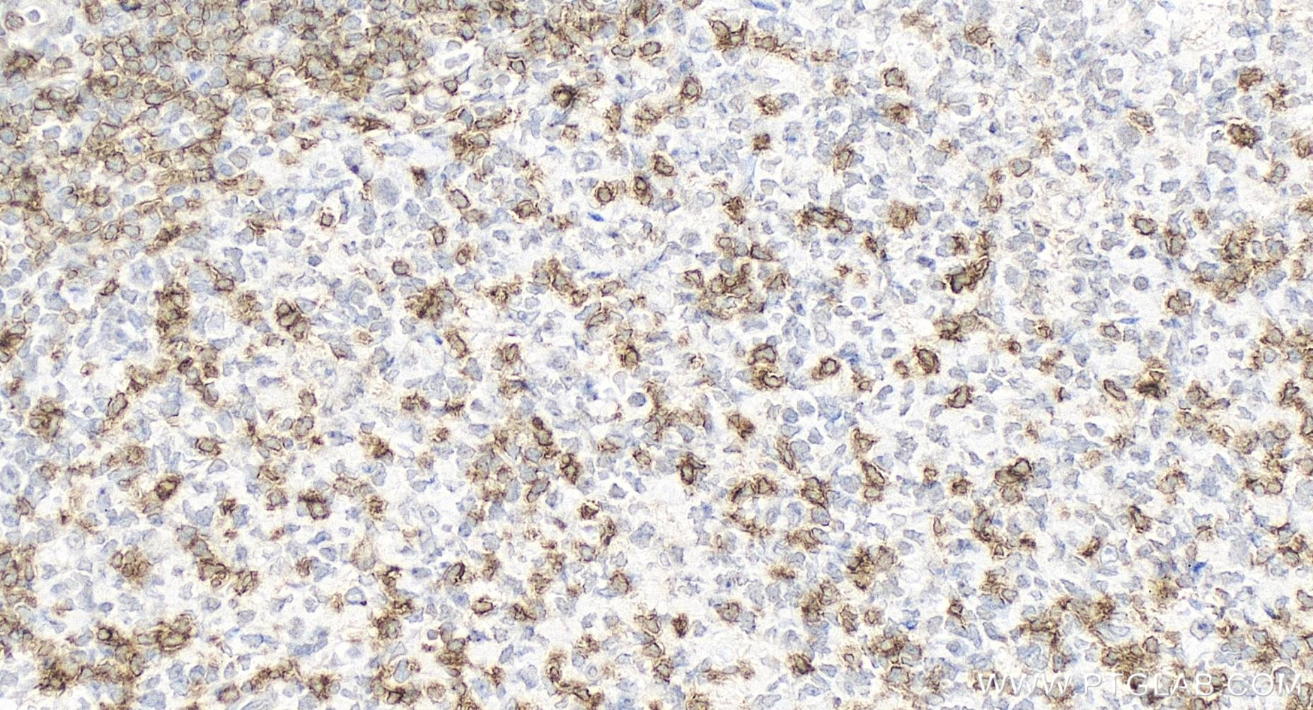 Immunohistochemistry (IHC) staining of human tonsillitis tissue using Anti-Human CD45RO (UCHL1) Mouse IgG2a Recombinant  (65613-1-MR)