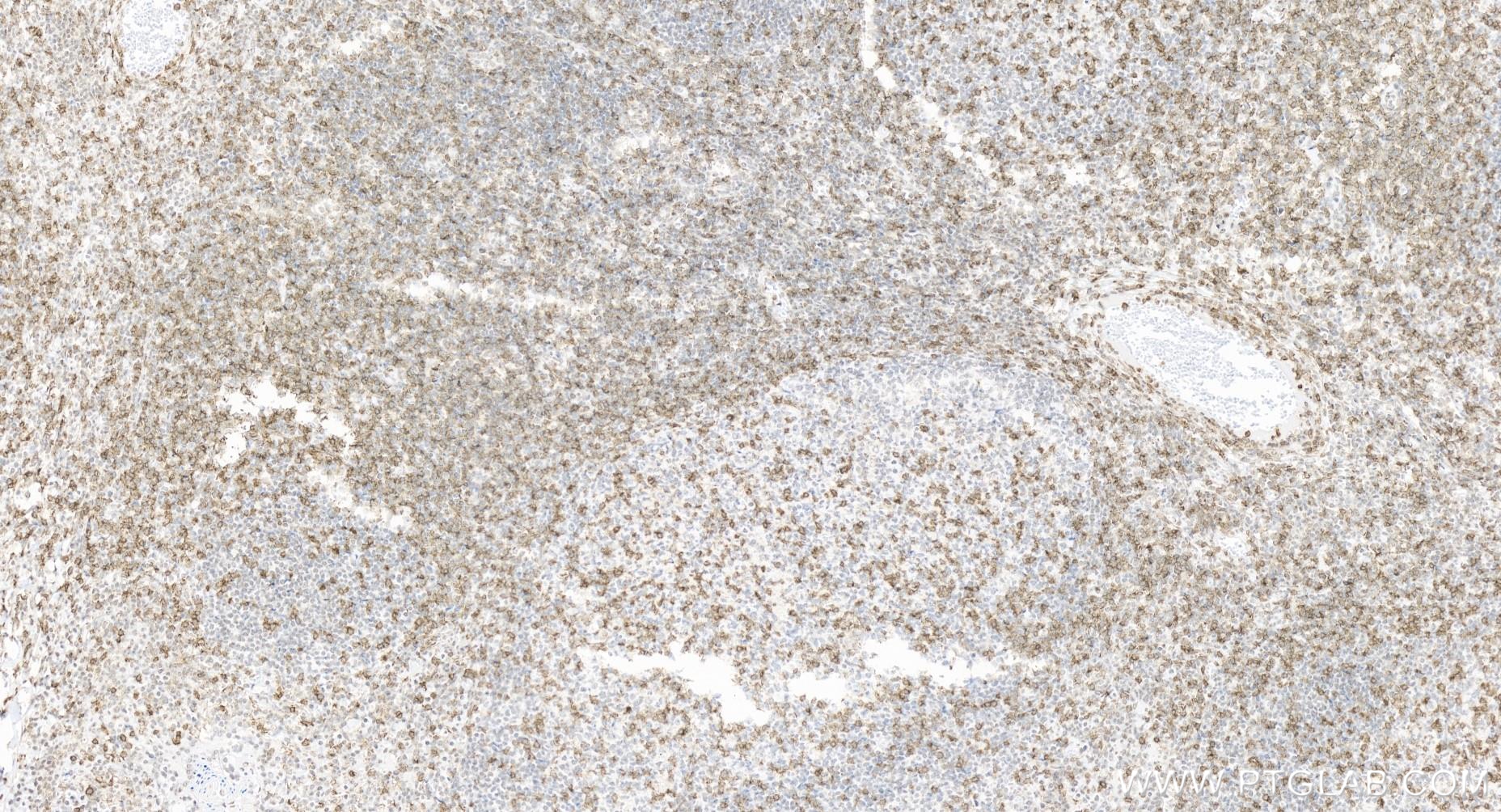 Immunohistochemistry (IHC) staining of human tonsillitis tissue using Anti-Human CD45RO (UCHL1) Mouse IgG2a Recombinant  (65613-1-MR)