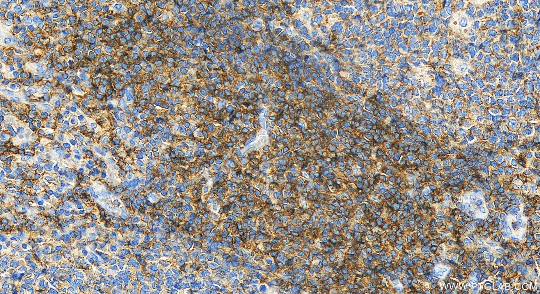 Immunohistochemistry (IHC) staining of human tonsillitis tissue using CD48 Polyclonal antibody (31945-1-AP)