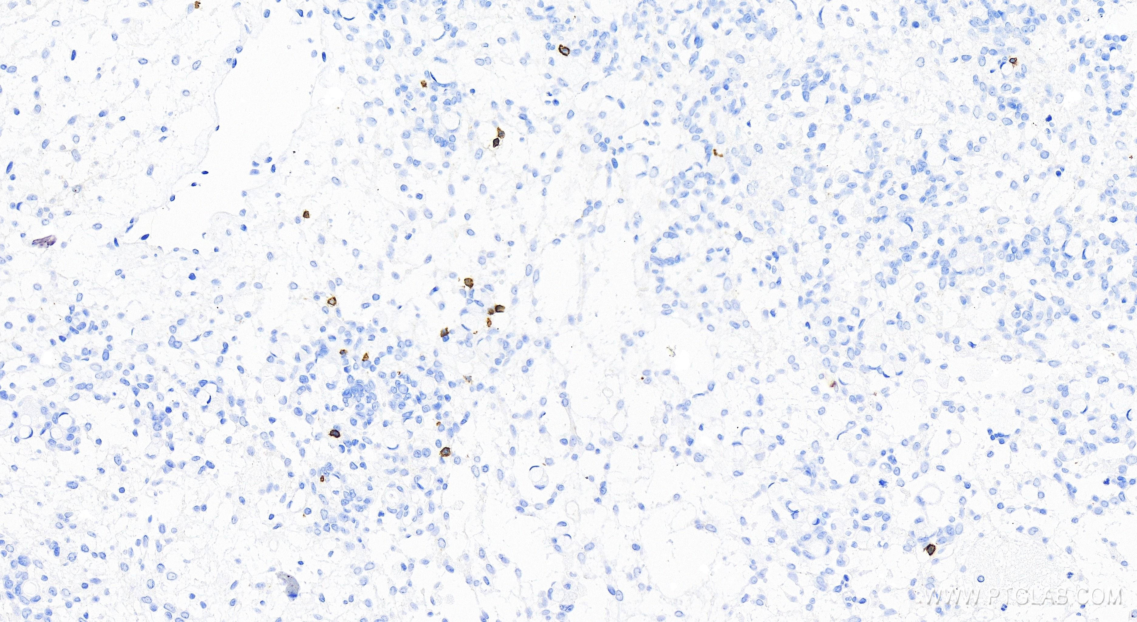 Immunohistochemistry (IHC) staining of human ovary cancer tissue using CD5 Recombinant antibody (83543-7-RR)