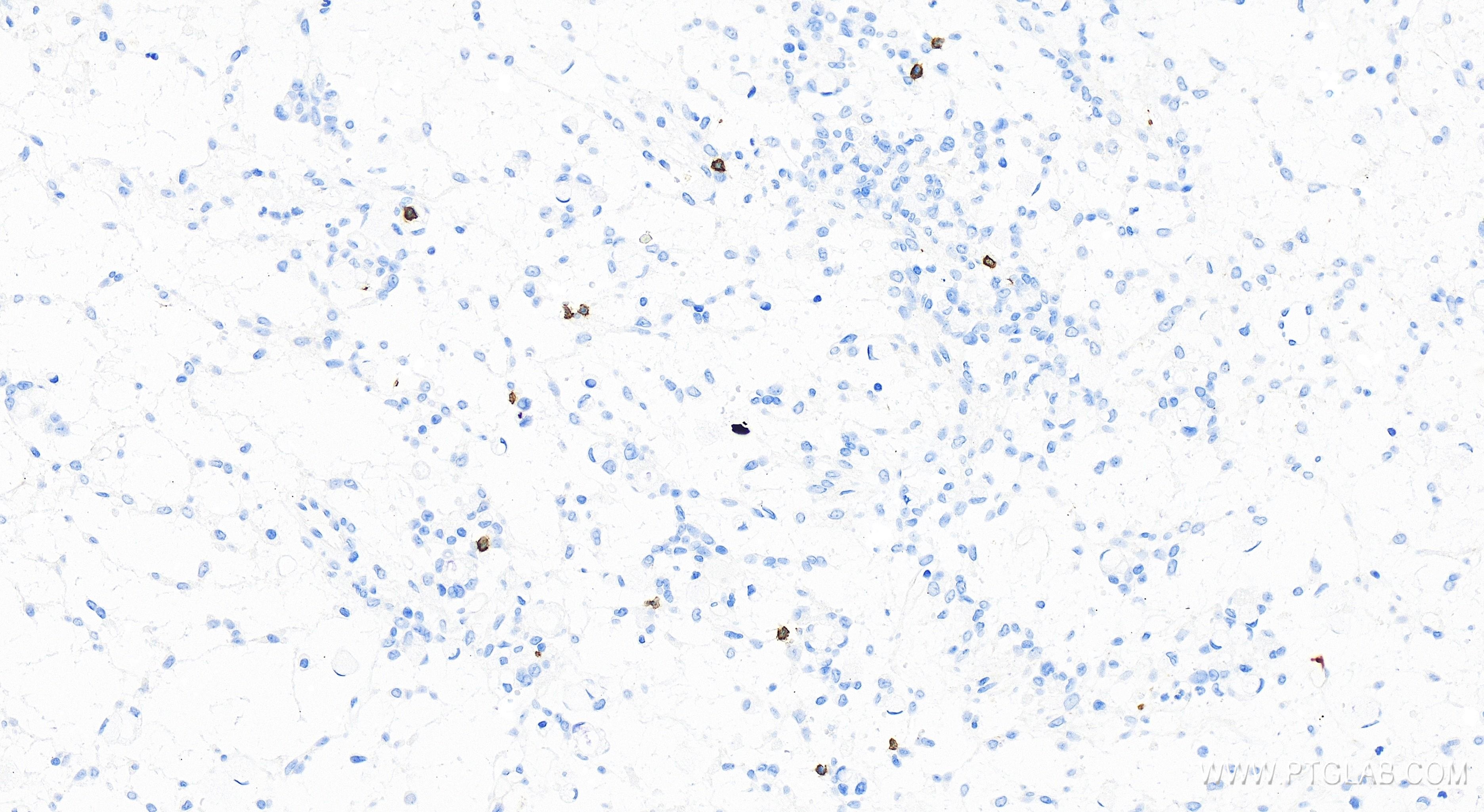 Immunohistochemistry (IHC) staining of human ovary cancer tissue using CD5 Recombinant antibody (83543-7-RR)