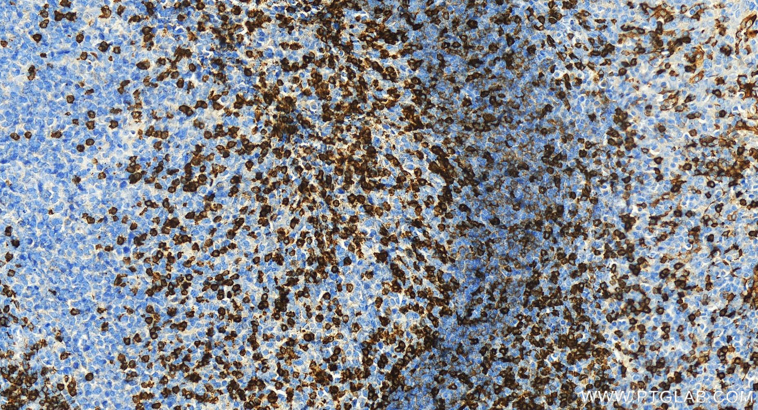 Immunohistochemistry (IHC) staining of human tonsillitis tissue using CD5 Recombinant antibody (83543-7-RR)