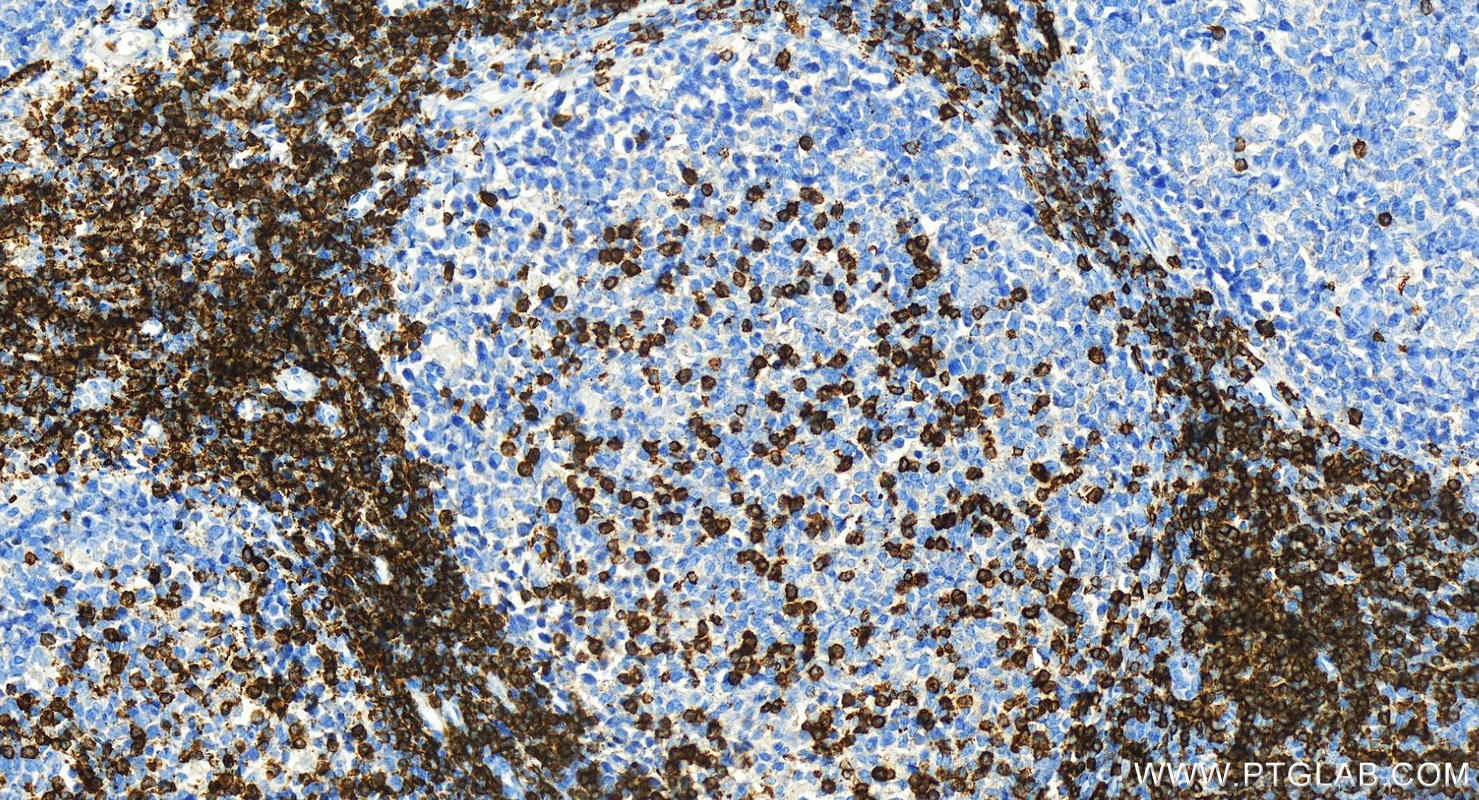 Immunohistochemistry (IHC) staining of human tonsillitis tissue using CD5 Recombinant antibody (83543-7-RR)