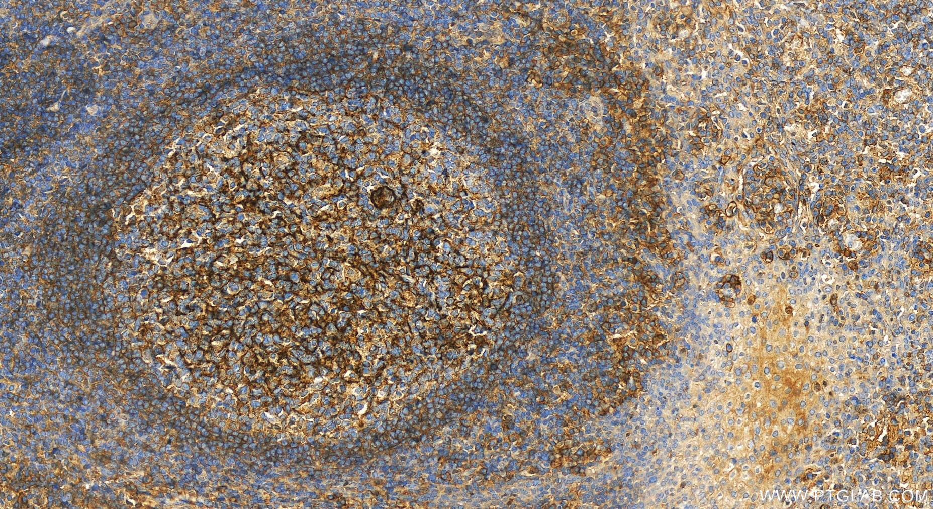 Immunohistochemistry (IHC) staining of human tonsillitis tissue using CD55 Polyclonal antibody (26580-1-AP)