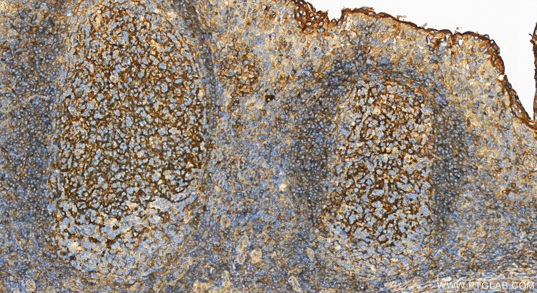 Immunohistochemistry (IHC) staining of human tonsillitis tissue using CD55 Polyclonal antibody (26580-1-AP)