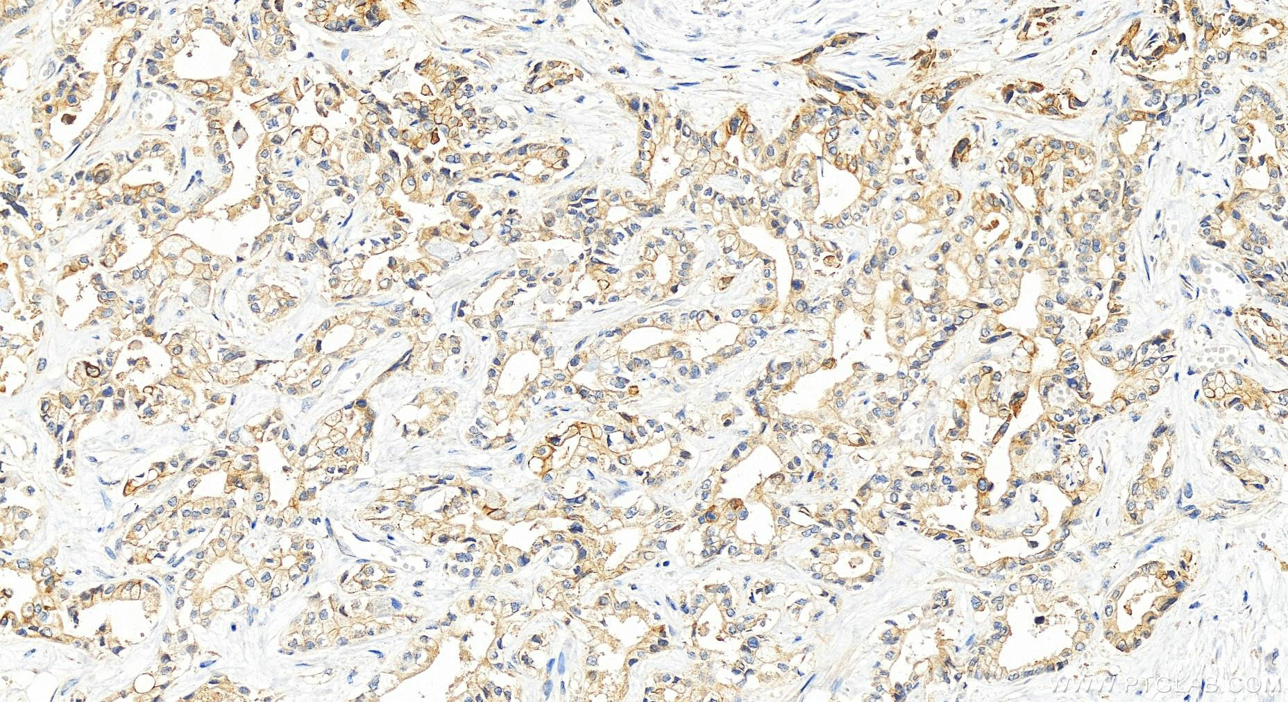 Immunohistochemistry (IHC) staining of human intrahepatic cholangiocarcinoma tissue using CD58 Polyclonal antibody (10878-1-AP)