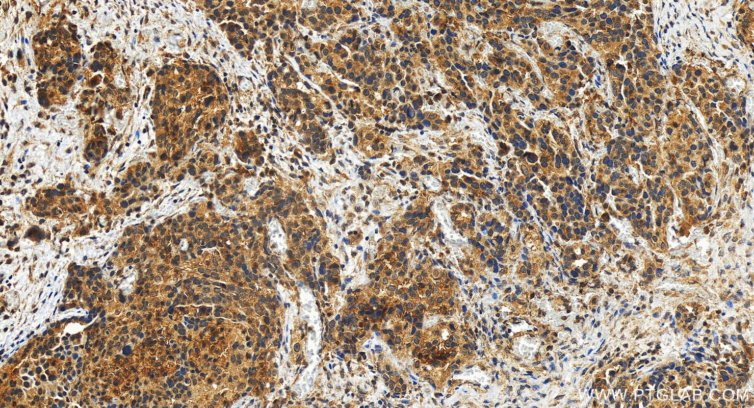 Immunohistochemistry (IHC) staining of human ovary cancer tissue using CD58 Polyclonal antibody (10878-1-AP)