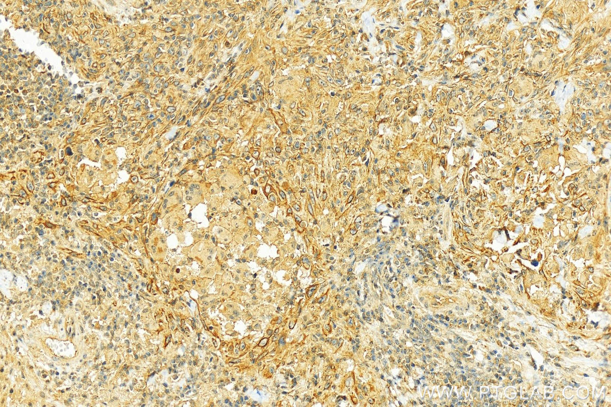 Immunohistochemistry (IHC) staining of skin cancer using CD58 Polyclonal antibody (10878-1-AP)