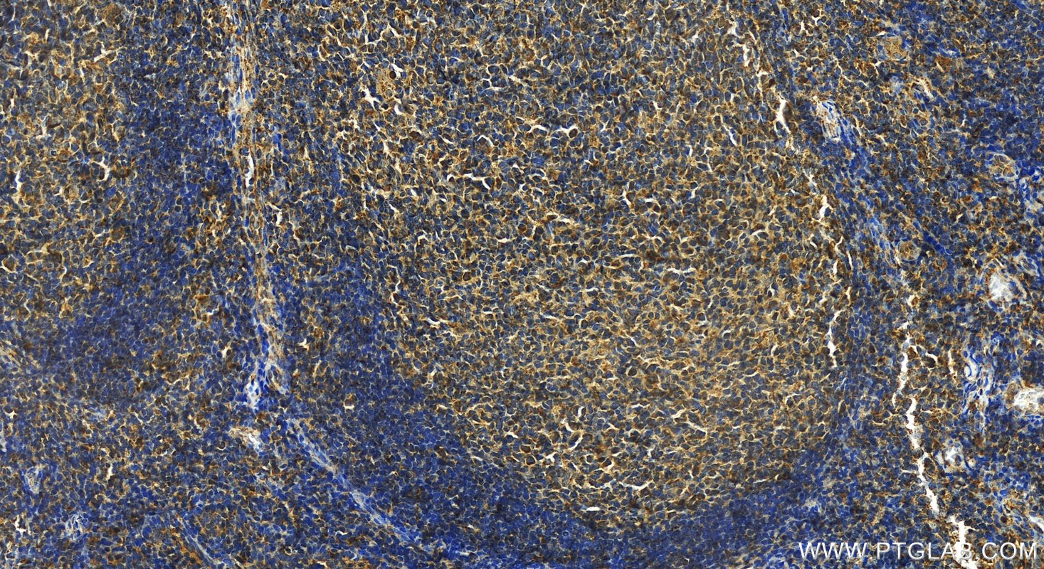 Immunohistochemistry (IHC) staining of human tonsillitis tissue using CD59 Polyclonal antibody (30223-1-AP)