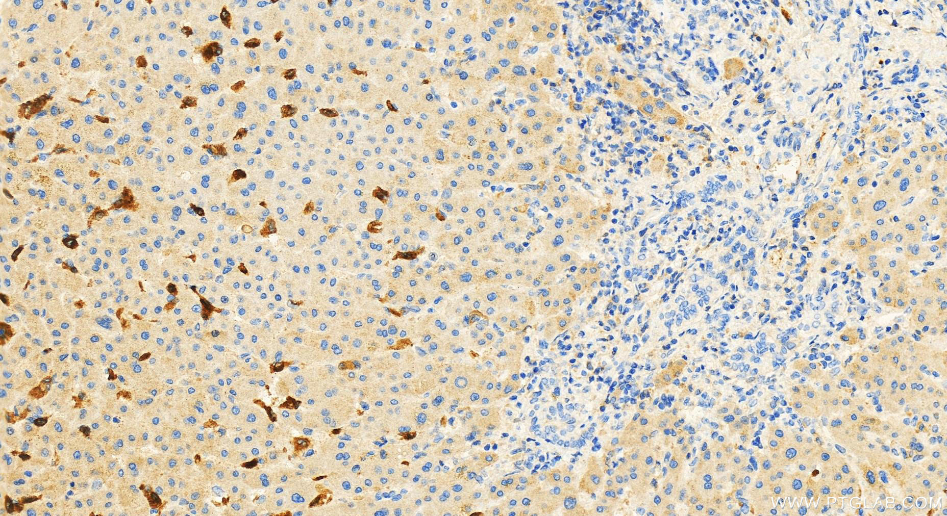 Immunohistochemistry (IHC) staining of human intrahepatic cholangiocarcinoma tissue using CD5L Polyclonal antibody (17224-1-AP)