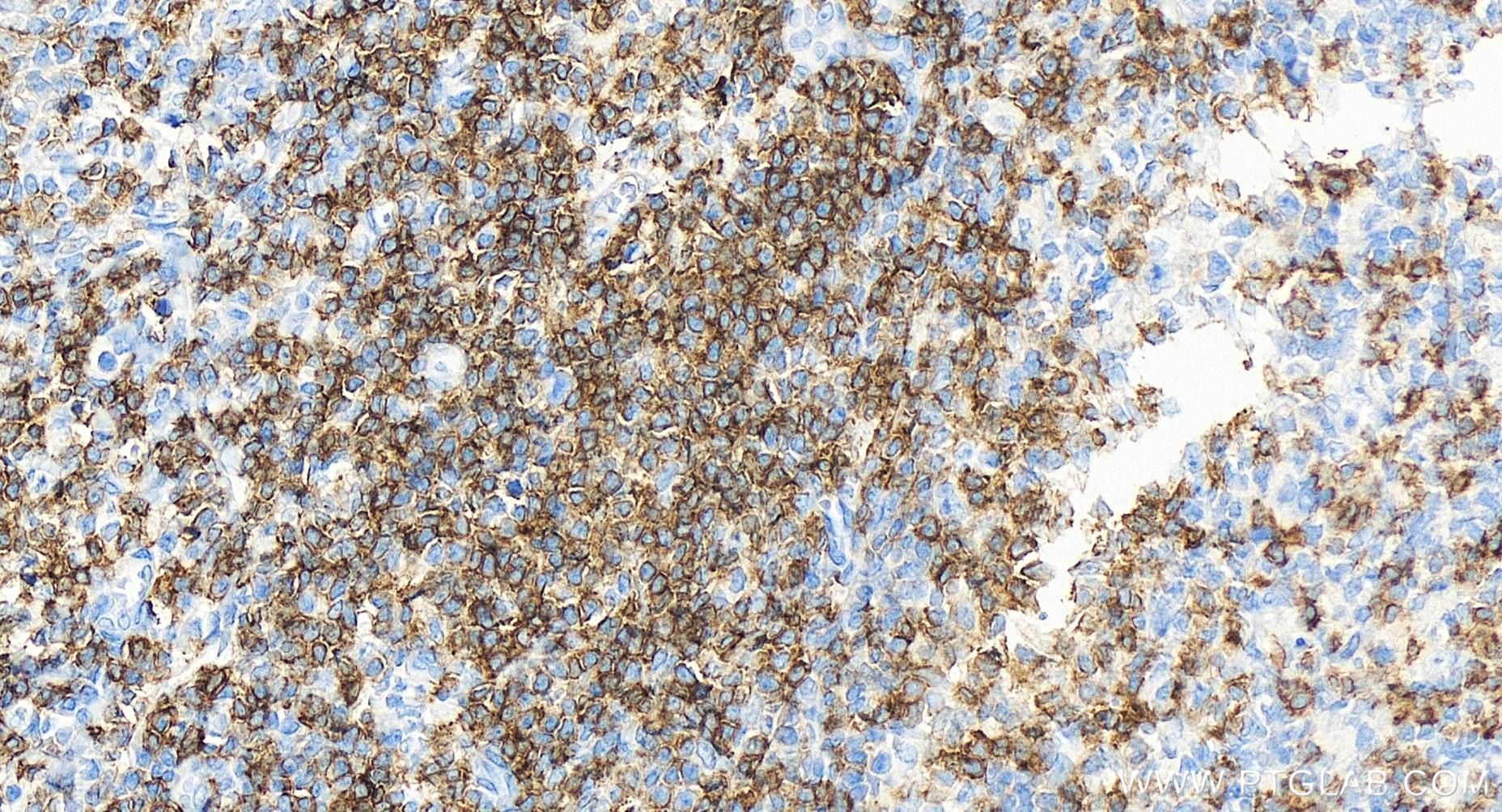 Immunohistochemistry (IHC) staining of human tonsillitis tissue using CD6 Recombinant antibody (84508-5-RR)