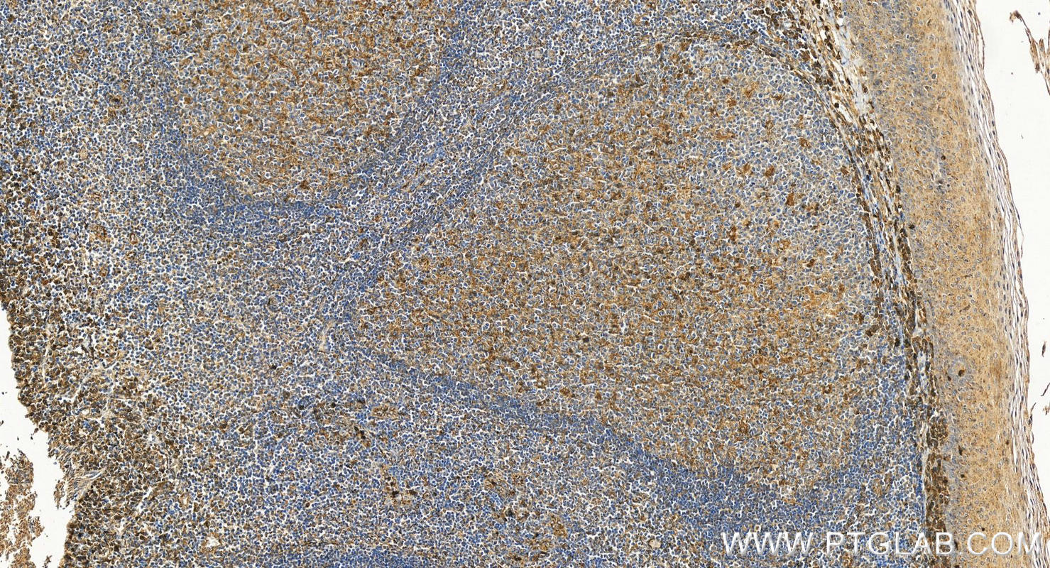 Immunohistochemistry (IHC) staining of human tonsillitis tissue using CD63 Polyclonal antibody (25682-1-AP)