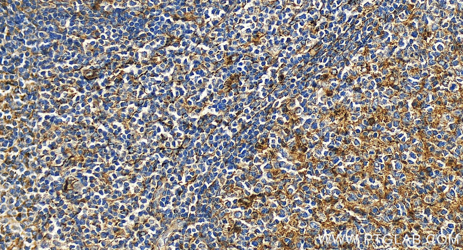 Immunohistochemistry (IHC) staining of human tonsillitis tissue using CD63 Polyclonal antibody (25682-1-AP)