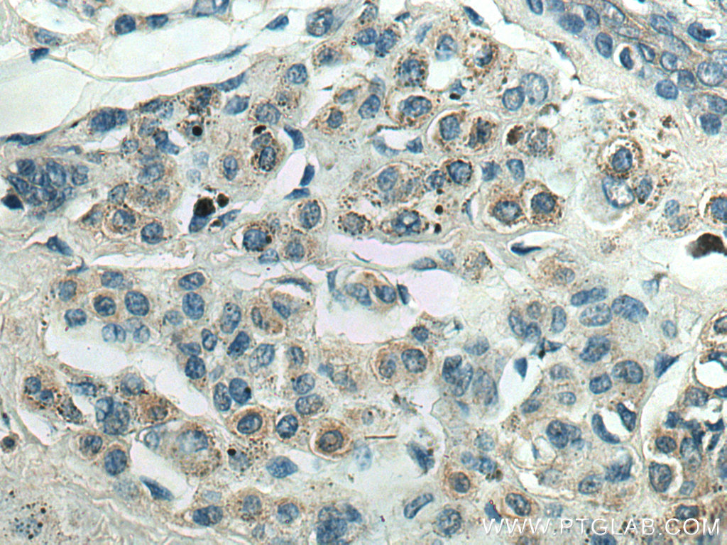 Immunohistochemistry (IHC) staining of human malignant melanoma tissue using CD63 Monoclonal antibody (67605-1-Ig)