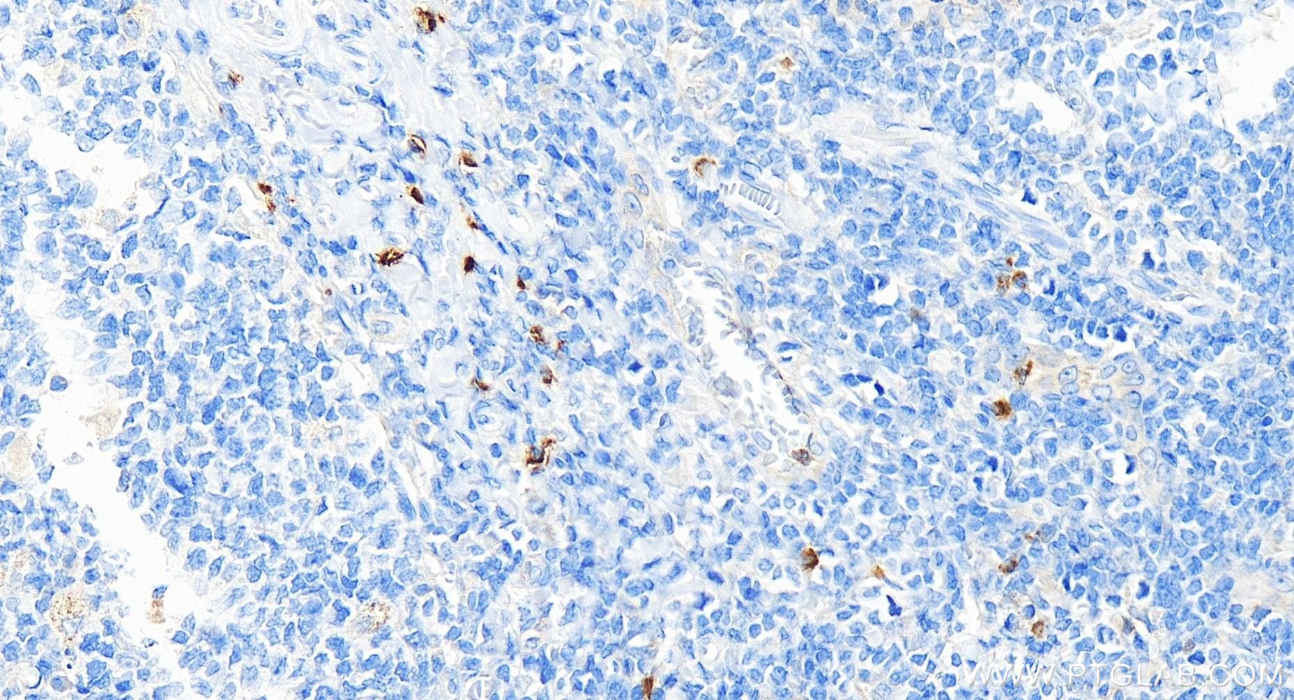 Immunohistochemistry (IHC) staining of human tonsillitis tissue using CD63 Recombinant antibody (84507-4-RR)