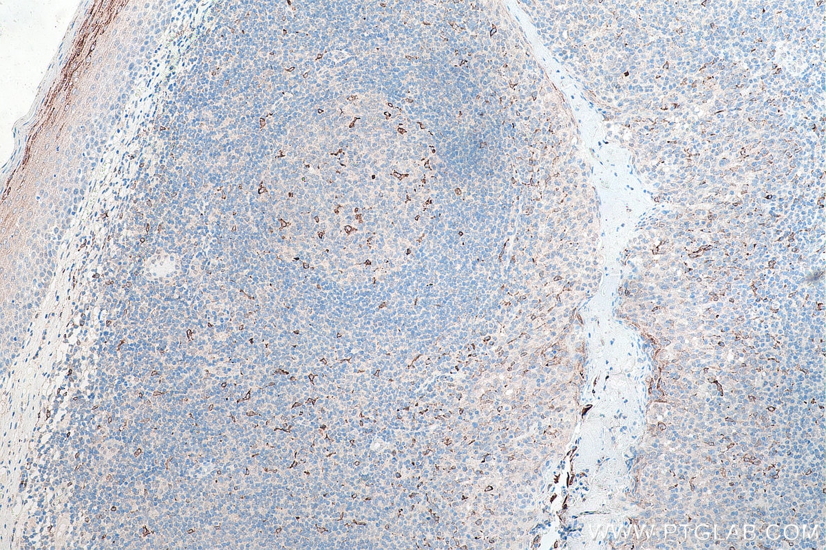 Immunohistochemistry (IHC) staining of human tonsillitis tissue using CD68 Monoclonal antibody (66231-2-Ig)