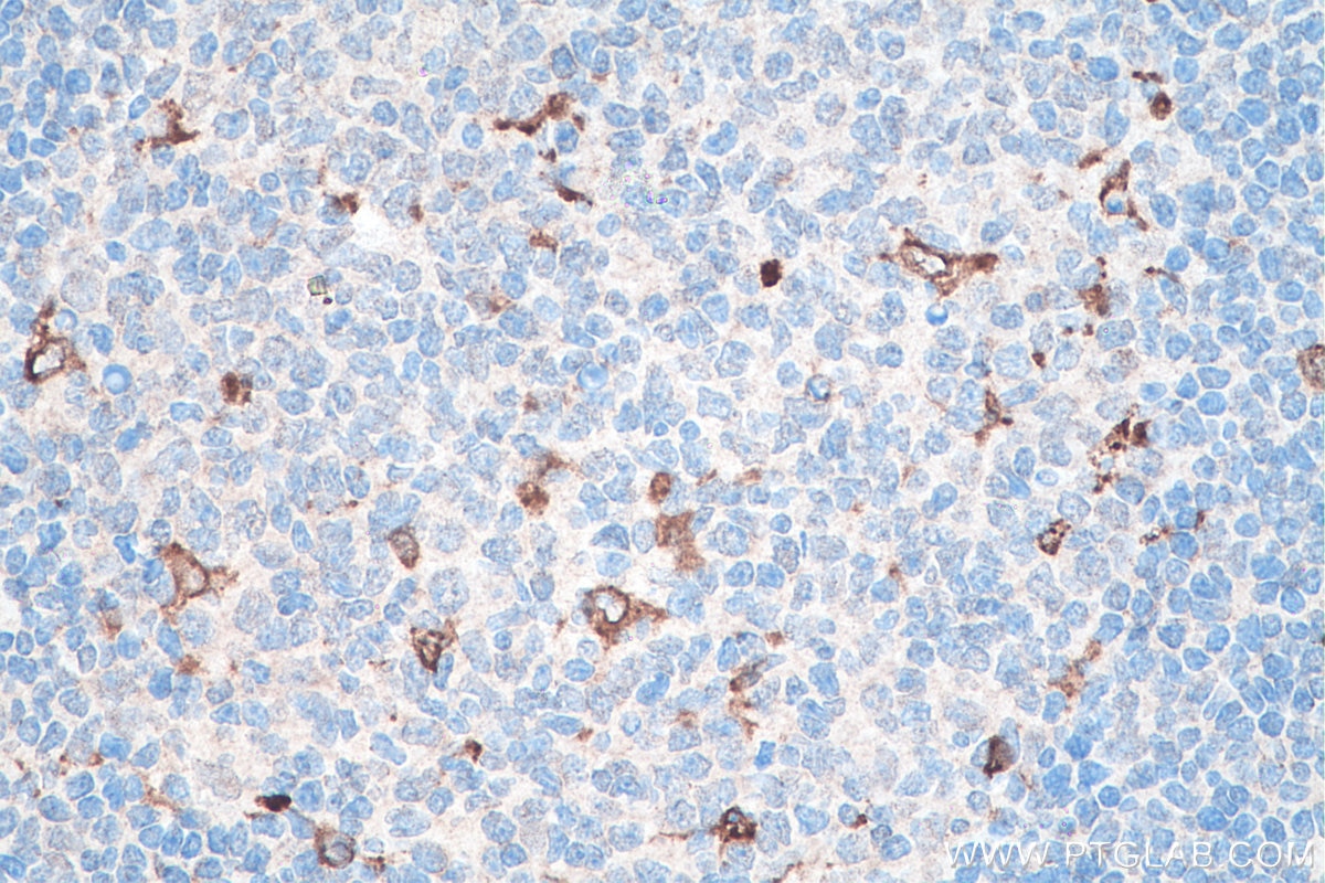 Immunohistochemistry (IHC) staining of human tonsillitis tissue using CD68 Monoclonal antibody (66231-2-Ig)