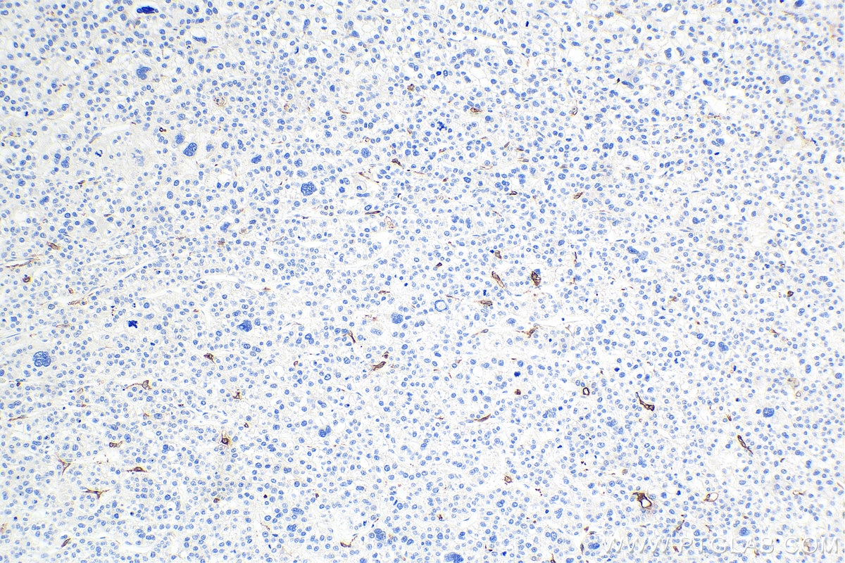 Immunohistochemistry (IHC) staining of human liver cancer tissue using CD68 Monoclonal antibody (66231-2-Ig)